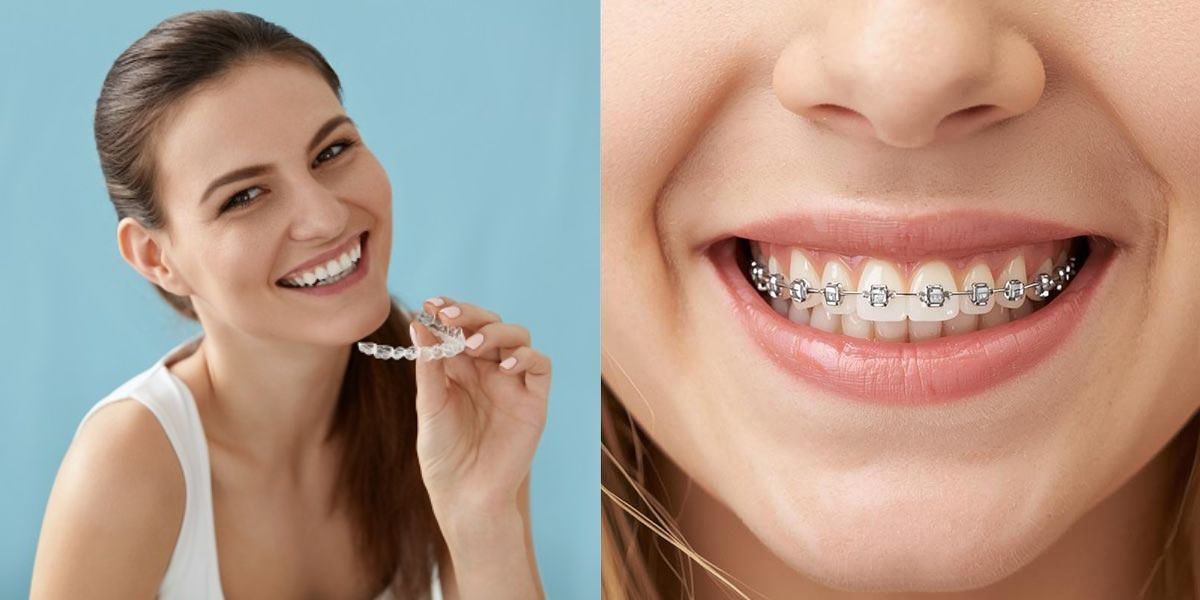 Benefits of Clear Aligners Over Braces