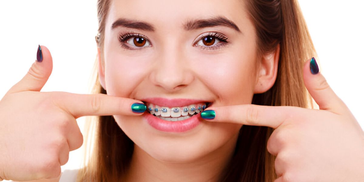 adult braces cost UK