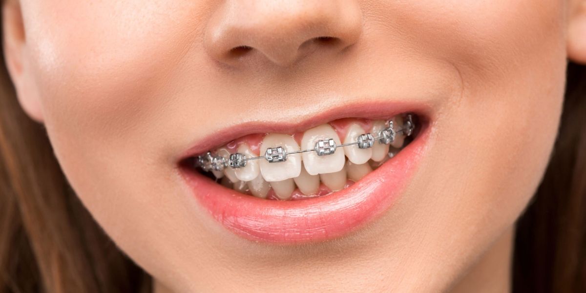 brace type for teeth
