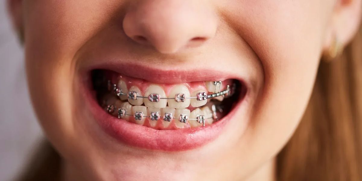 braces types