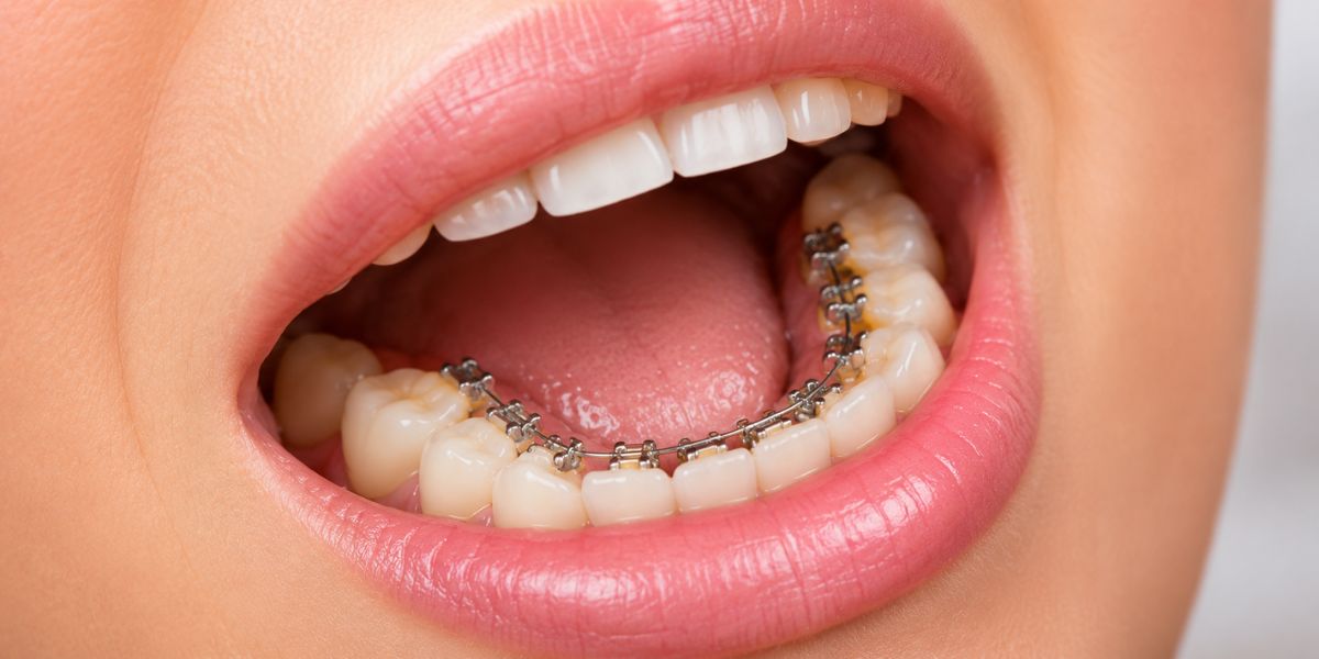 different braces types