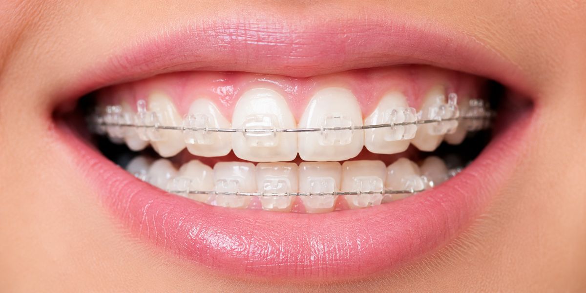 different types of braces