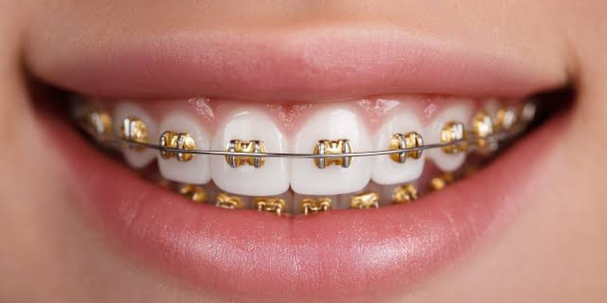 what are the types of braces