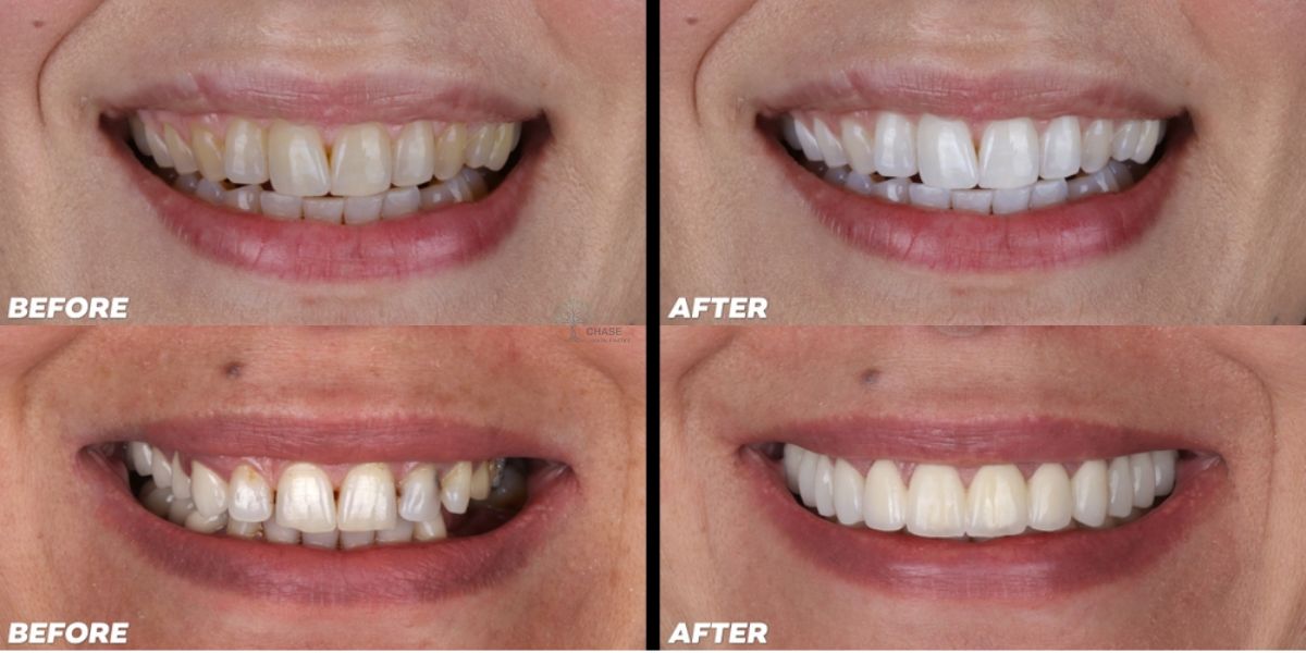 Smile Makeover Consultation Cannock