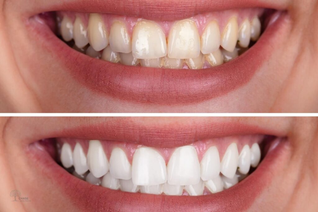 Teeth Whitening Treatment Cannock