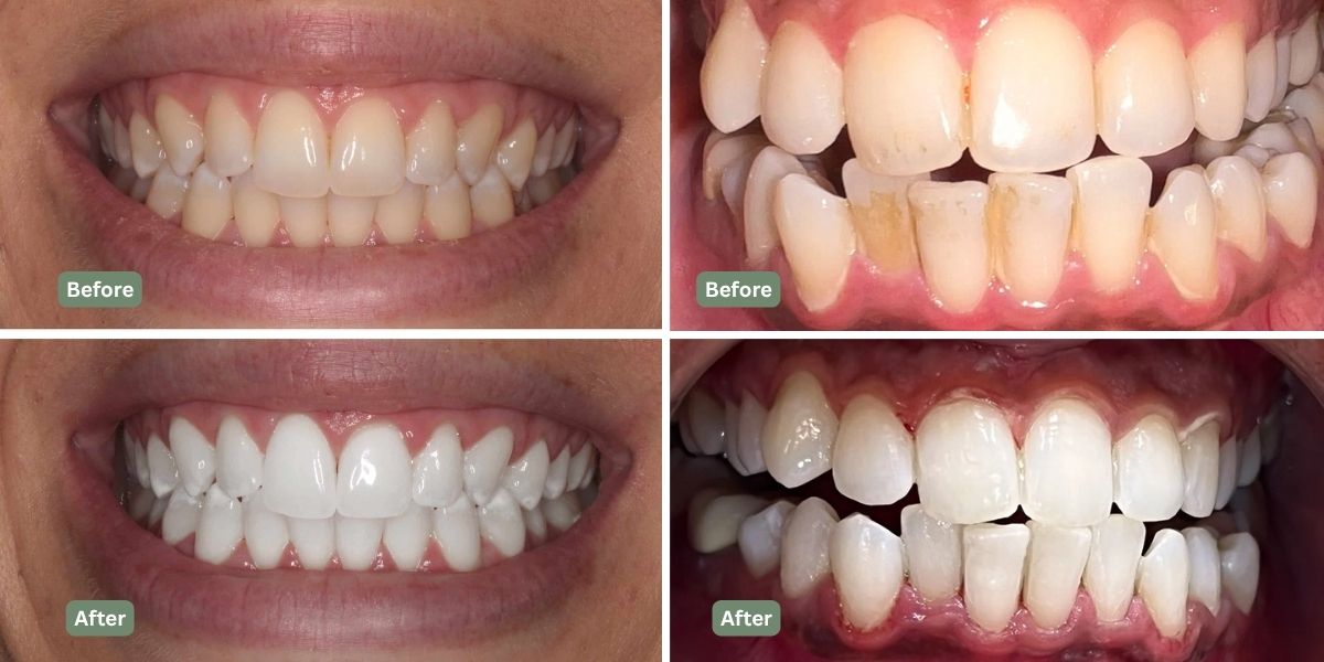 Is Teeth Whitening Worth the Money